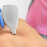 Лазерная эпиляция спины у женщин: показания, подготовка, преимущества